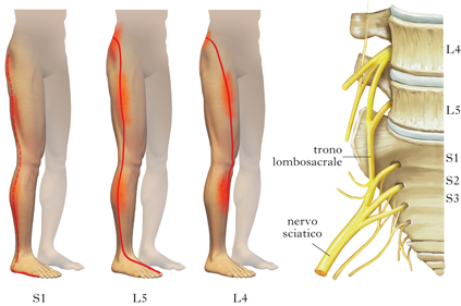 sciatica