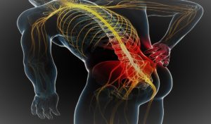 sciatica lombosciatalgia sebastian guzzetti bergamo dolore sciatalgia