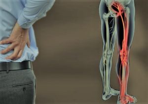 sciatica sciatalgia lombosciatalgia osteopatia sebastian guzzetti