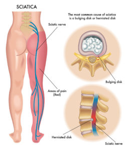 sciatica sciatalgia lombosciatalgia bergamo sebastian guzzetti