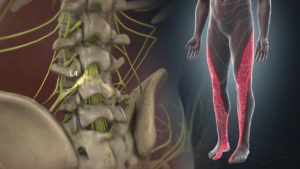 sciatica