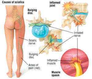 sciatica dolore guzzetti sebastian osteopata bergamo
