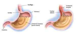 reflusso gastroesofageo osteopatia