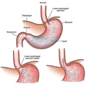 reflusso gastroesofageo osteopatia