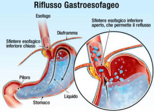 reflusso gastroesofageo osteopatia
