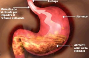 reflusso gastroesofageo osteopatia