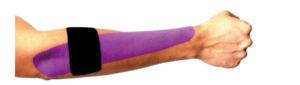 epicondilite