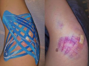 kinesio taping