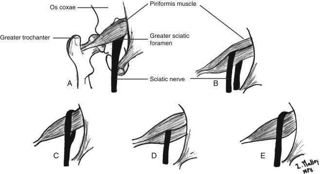 piriforme nervo sciatico