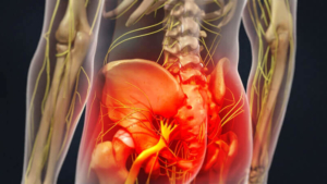 sindrome del piriforme