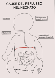 Reflusso nel neonato cause