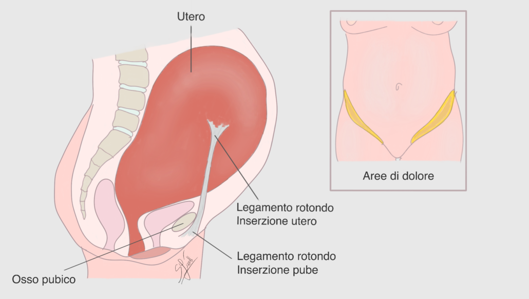 Pubalgia in gravidanza