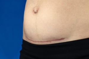 Cicatrice del cesareo